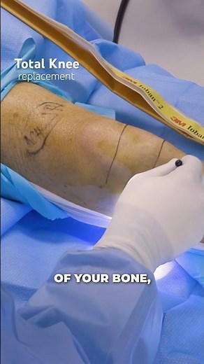 The Most Common Knee Replacement Incision — How Surgeons Access Your Joint