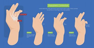 Dupuytren’s disease treatment | Arizona Center for Hand Surgery