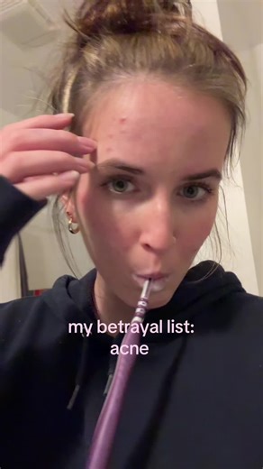 #fyp #acne #accutane #fypシ゚viral #relatable | acne