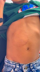 Diagnosis:::Tinea corporis #skindisease | Nazmur Shakir Setu