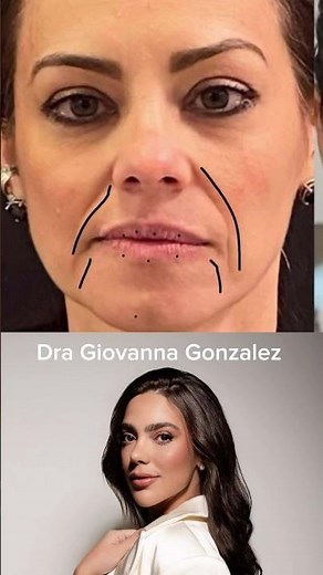 😱STUNNING FACIAL HARMONIZATION, Dr. Giovanna Gonzalez, subscribe to the channel!