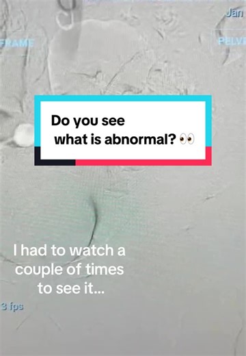 Uncovering the Hidden Details in Angiogram Videos