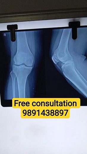 Immediate treatment of knee to avoid operation