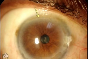 14 reactions | Terrien's Marginal Degeneration #eye #health #cornea | Dr. Benjamin Karimov | Facebook