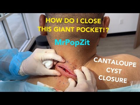 GIGANTIC CYST ON NECK CLOSURE. See how I use sutures to close deep pocket.Link to his excision below
