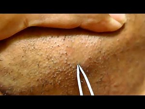 From Pluck to Glow Preventing and Treating Ingrown Facial Hair