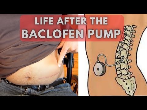 From uncontrollable spasms to relaxed limbs | Life before and after a Baclofen Pump