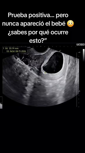Embarazo Anembrionado: Diagnóstico y Manejo