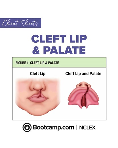 👶 Cleft Lip & Palate NCLEX Review | NCLEX Bootcamp Cheat Sheet