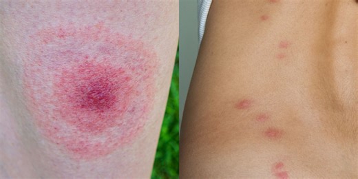 What Bit You? 17 Bug Bite Pictures to Help You ID—and Treat—Your Itch Fast