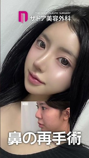 分厚い鼻先を改善⭐ 団子鼻矯正で変わったイメージ⭐下がった鼻先を上げたビフォーアフター！ アイドル顔に変身💕 #整形 #ビフォアーアフター#鼻整形 #美容 #鼻中隔延長 #団子鼻 #鼻先 #垢抜け