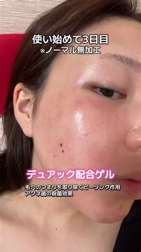 私が3週間で肌をきれいにした方法🪄