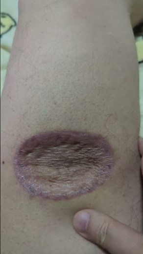 2/16 Today's rare cancer melanoma and Opdivo side effects (´・ω・`)