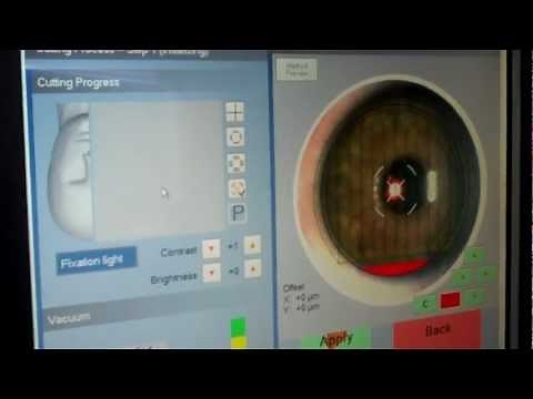 Z-Lasik Bladeless Lasik Advanced Ziemer Femtosecond Laser in Arizona Patient B