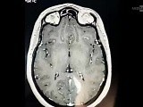 Extended Transnasal Transsphenoidal Transpterygoid Approach for Resection of an Invasive Pituitary Adenoma • Video • MEDtube.net