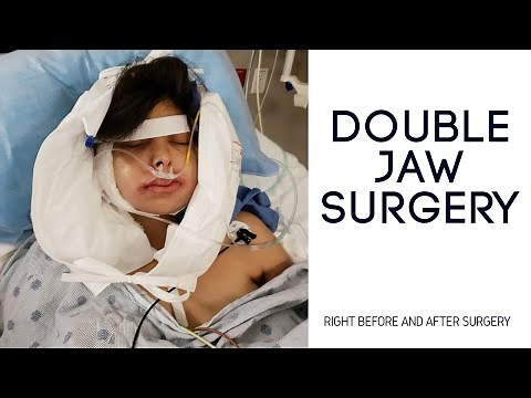 Double Jaw Surgery, Lefort 1, BSSO