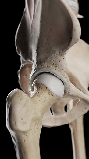 482K views · 4.5K reactions | 領 Hip Arthrosis: When the Hip Joint...