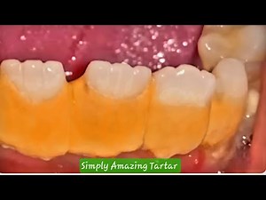 Tartar / Calculus Removal Back of teeth cleaning - Satisfying #subscribe #tartarremoval #shorts