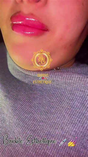 #lips #russian #injection #marseille #filler