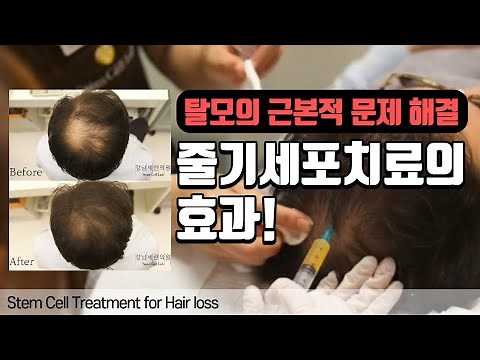 탈모의 근본적 해결책! 줄기세포치료! Stem Cell Treatment for Hair loss #Perawatan rambut rontok dengan sel induk