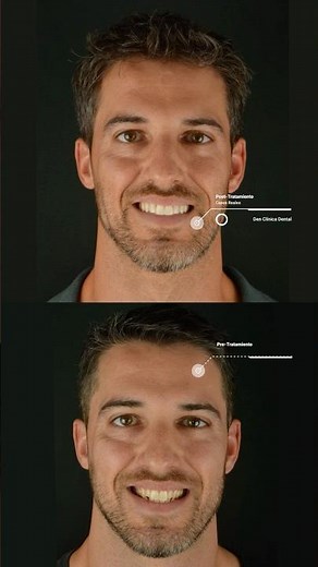 Antes y después: transformación de sonrisa con bruxismo | Carillas dentales en Granollers