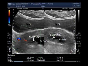 Ultrasound Video showing Missed abortion also called a Missed miscarriage.