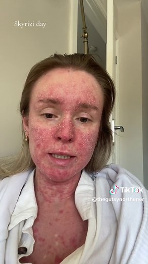 Understanding Skyrizi for Autoimmune Disease Treatment