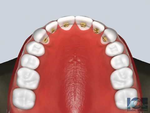 Bonded Retainer (Upper)