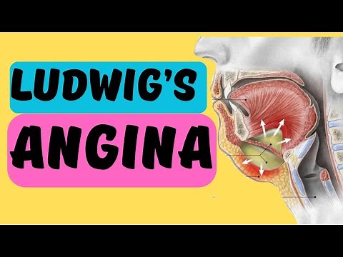 Ludwig's Angina | Explained in 2 minutes! Signs, Symptoms and Treatment | Angina Ludovici
