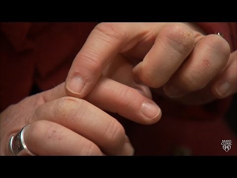 Mayo Clinic Minute: Winter skin protection ideas