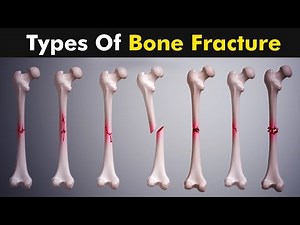 Breaking Down Femur Fractures : What You Need to Know