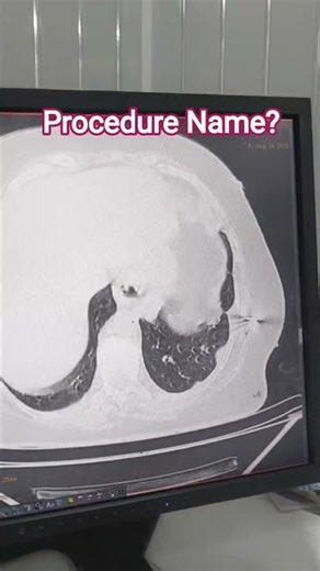 CT guided lungs biopsy for soft tissue legion#radiologist #ctscan #trending