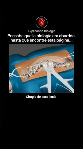 cirugia de escoliosis