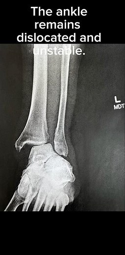 This is a classic Maisonneuve fracture: injuries are easy to miss if you only focus on the ankle.