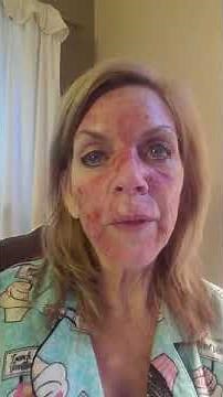 Skin cancer Fluorouracil Topical treatment Day 20