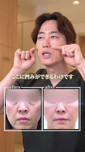 Nasolabial Fold Treatment Case Study | Sagging Skin Treatment