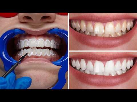4 Best Ways To Whiten Your Teeth