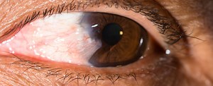 Pterygium & Pinguecula - Exeter Eye