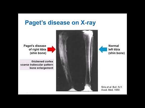 What is Paget’s Disease of Bone and how does bisphosphonate treatment work? Dr Daroszewska explains.