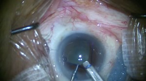 Besser Forceps for Malyugin Ring Insertion - Eyetube