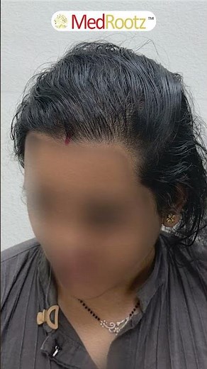 Precision | Expertise | Natural Female Hair Transplant Transformation | MedMagic at MedRootz