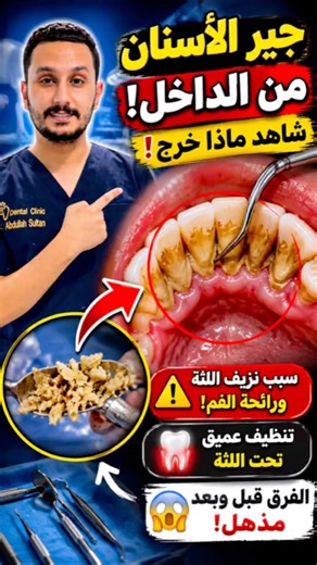 لن تصدق كمية الجير المختبئة تحت اللثة! شاهد التنظيف العميق للأسنان #dentist #dentistry #dr_abdullah