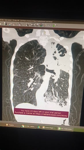 HRCT chest Of 80 Year Male chest at Toshiba machine | #shorts #trending #trendingshorts #viral #ct