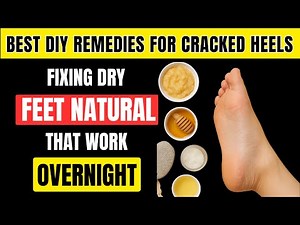 How to Heal Dry, Cracked Feet Fast at Home | Natural Foot Care Tips