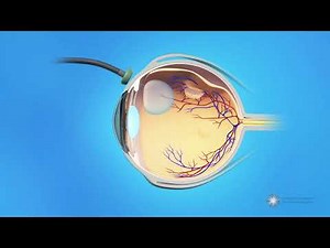 Vitrectomy Surgery for Detached Retina - Lancaster Retina Specialists