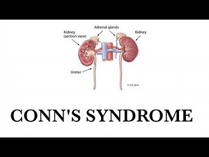 Conns syndrome || Hyperaldosteronism