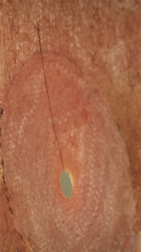 West System on Instagram: "🛠️ Need a temporary backer for a fiberglass hole repair? Try this quick trick! 👉 Watch the full step-by-step thru-hull repair tutorial on YouTube! Search "No More Sink Drain! Sealing a Thru-Hull with Fiberglass and WEST SYSTEM Epoxy" or use the link in our bio. 🔗 #WESTSYSTEMEpoxy #ThruHullRepair #MarineRepair #Fiberglassing #BoatRepair"