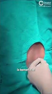 💡 Paramedian Approach for Spinal Anesthesia | Dr. Jhanvi Bajaj | Conceptual Anesthesia