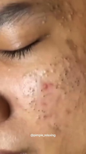 Time to relax 🧘‍♀️ #blackheads #supersatisfying #extractionsatisfaciton #pimplepop