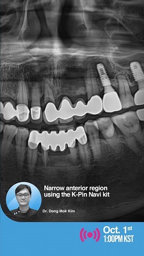 MegaGen Implant | Dr. Park’s Implant Surgery Room – Special Live Session with Dr. Dong Mok Kim! 🦷 Narrow anterior region using the K-Pin Navi Join us on... | Instagram